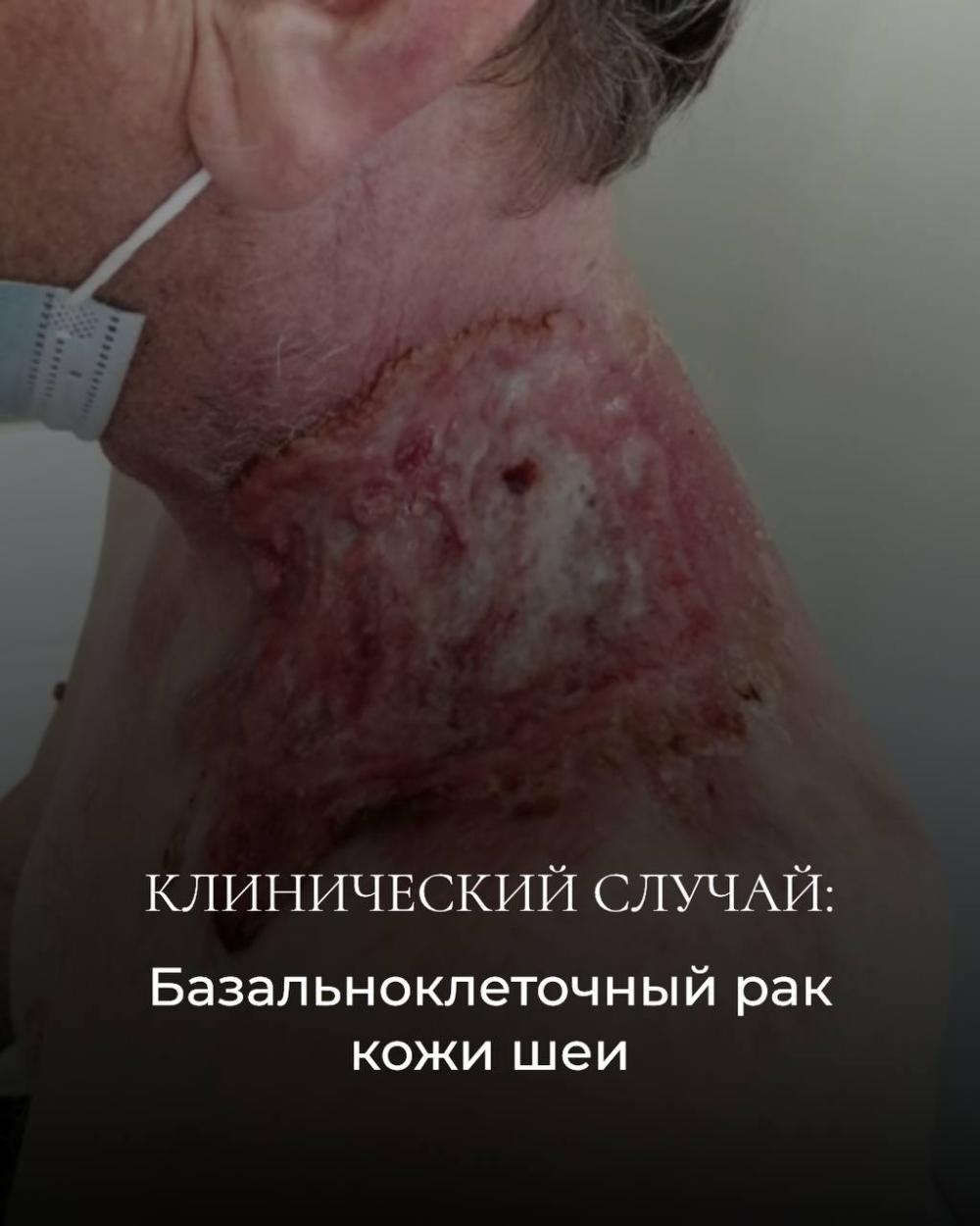 Как современная лучевая терапия помогает даже в запущенных случаях