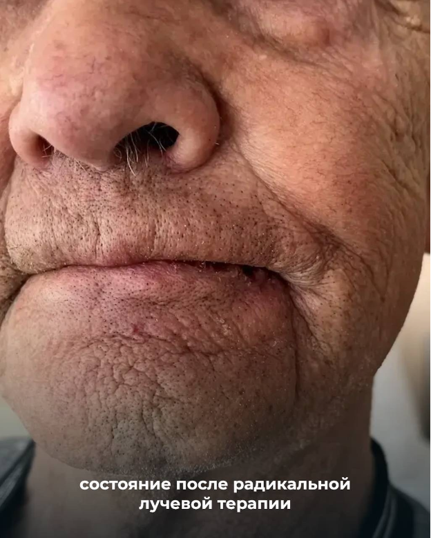 Ивановским онкологам удалось сохранить нижнюю губу пациента и излечить от рака - «ювелирная» работа нашей дружной команды наглядно